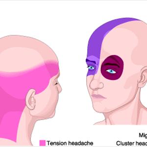 Best Migraine Medication - The Migraine Headache