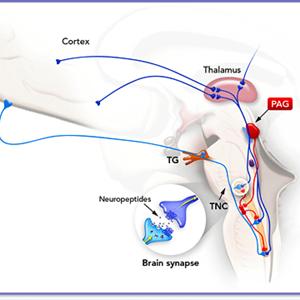 Sinus Headache - Migraine Food Triggers