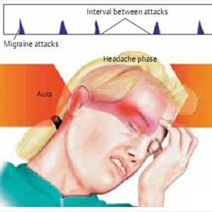 Persistent Migraine Answers - Clinical Study On Migraine In Traditional Chinese Medicine