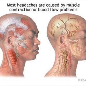 Butalbital Headache - Ocular Migraine - Symptoms And Treatment