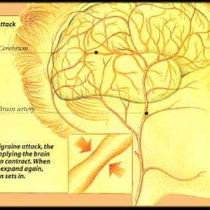 Pfo Migraine Trial - Wheat As A Migraine Trigger