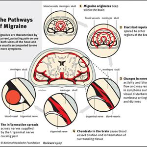 Tension Migraine - Migraine Headaches Hurt! Get Help!